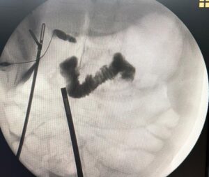 Tampak kontras mask dari gallbladder dan tanya masuk ke usus saja tanpa mengisi biliary tree