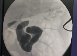 Tampak contras masuk dari galbladder ke usus dan biliary tree